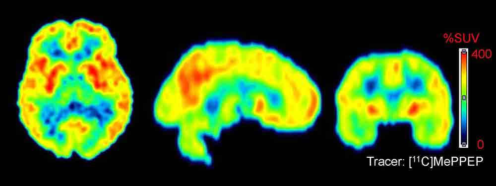Cannabinoid lindert Symptome bei Parkinson