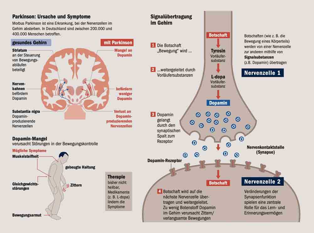 Parkinson-Krankheit: Die Diagnose kommt oft zu spät